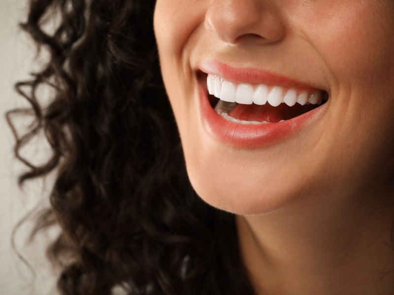 dental veneers in tampa