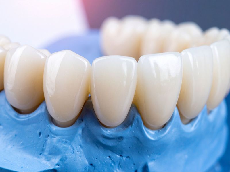 tampa dental fillings