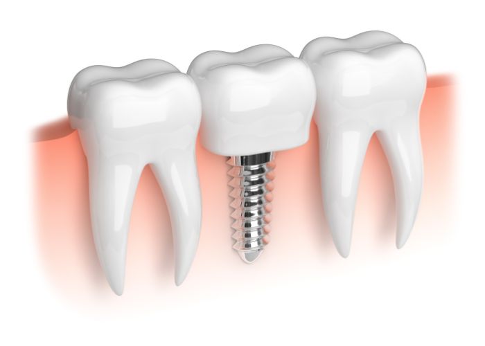 dental implants in tampa florida