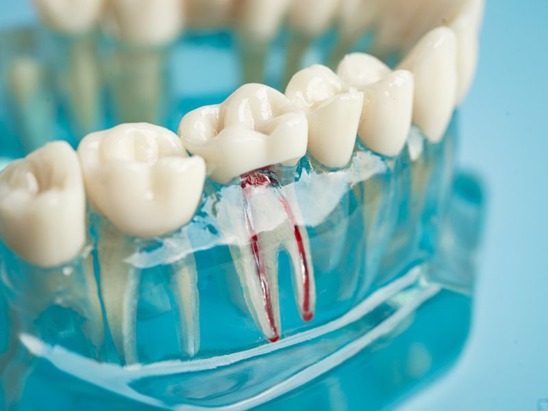 root canal in tampa