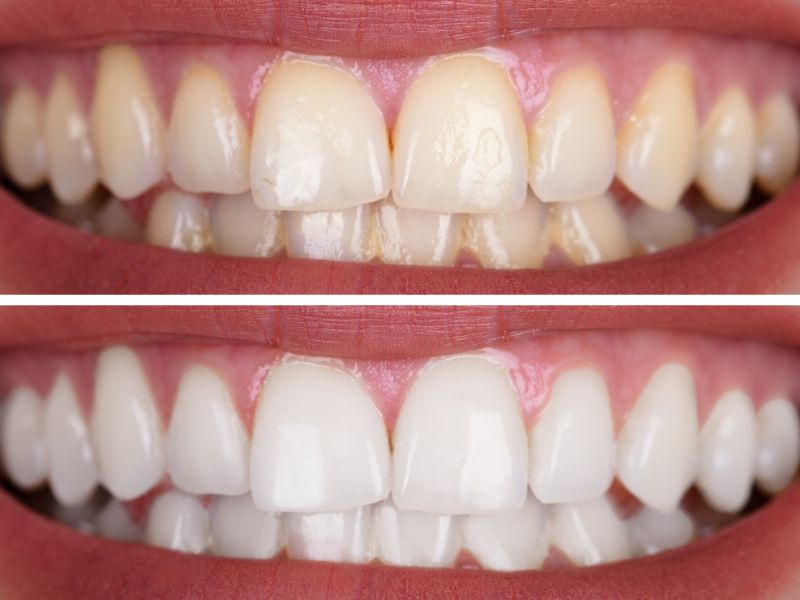 teeth whitening tampa florida	