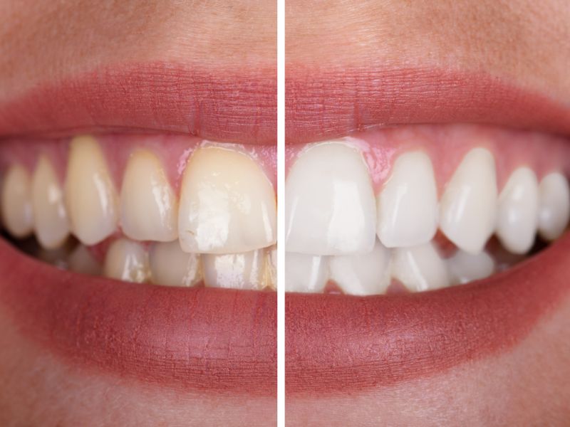 professional teeth whitening tampa fl